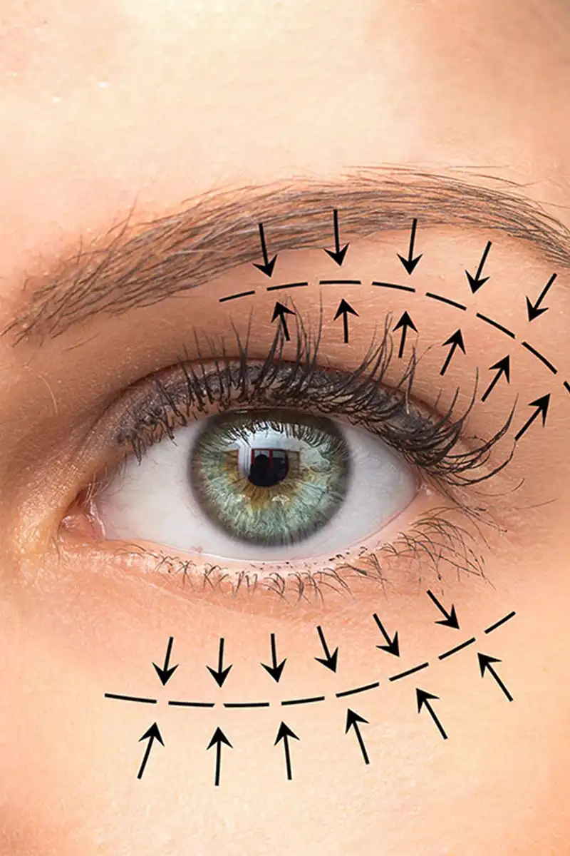 img-blefaroplastia-en-pereira-1