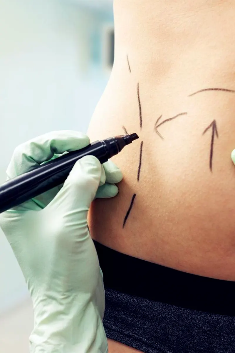 img-liposuccion-en-pereira-1